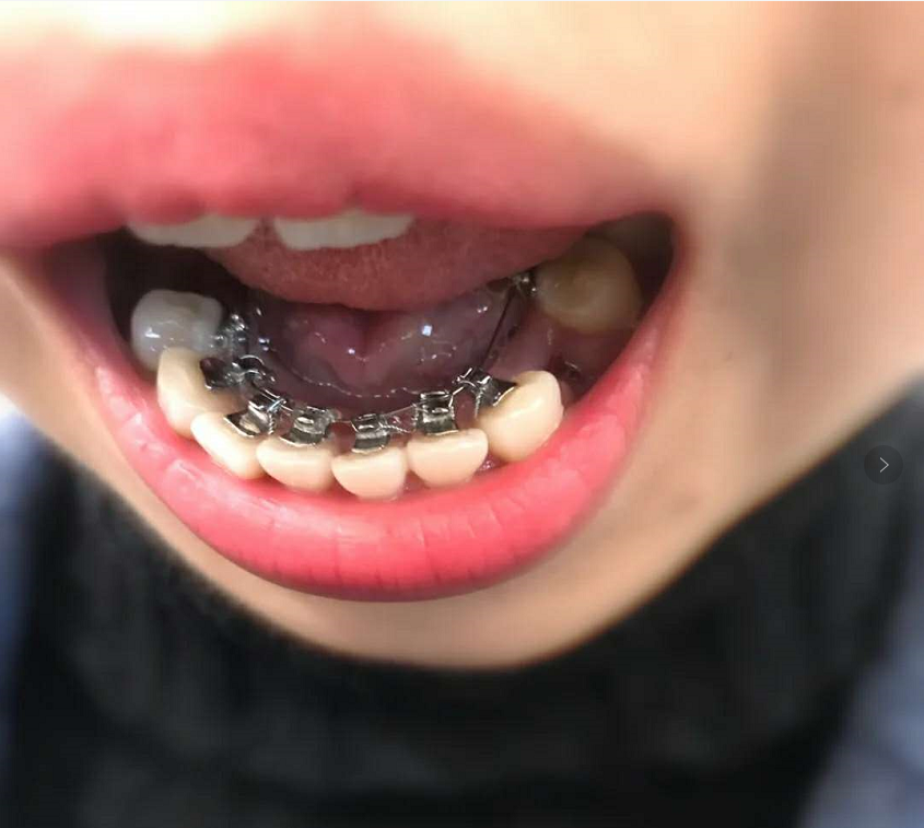 exo吴世勋做了矫牙怎么不见他戴牙套