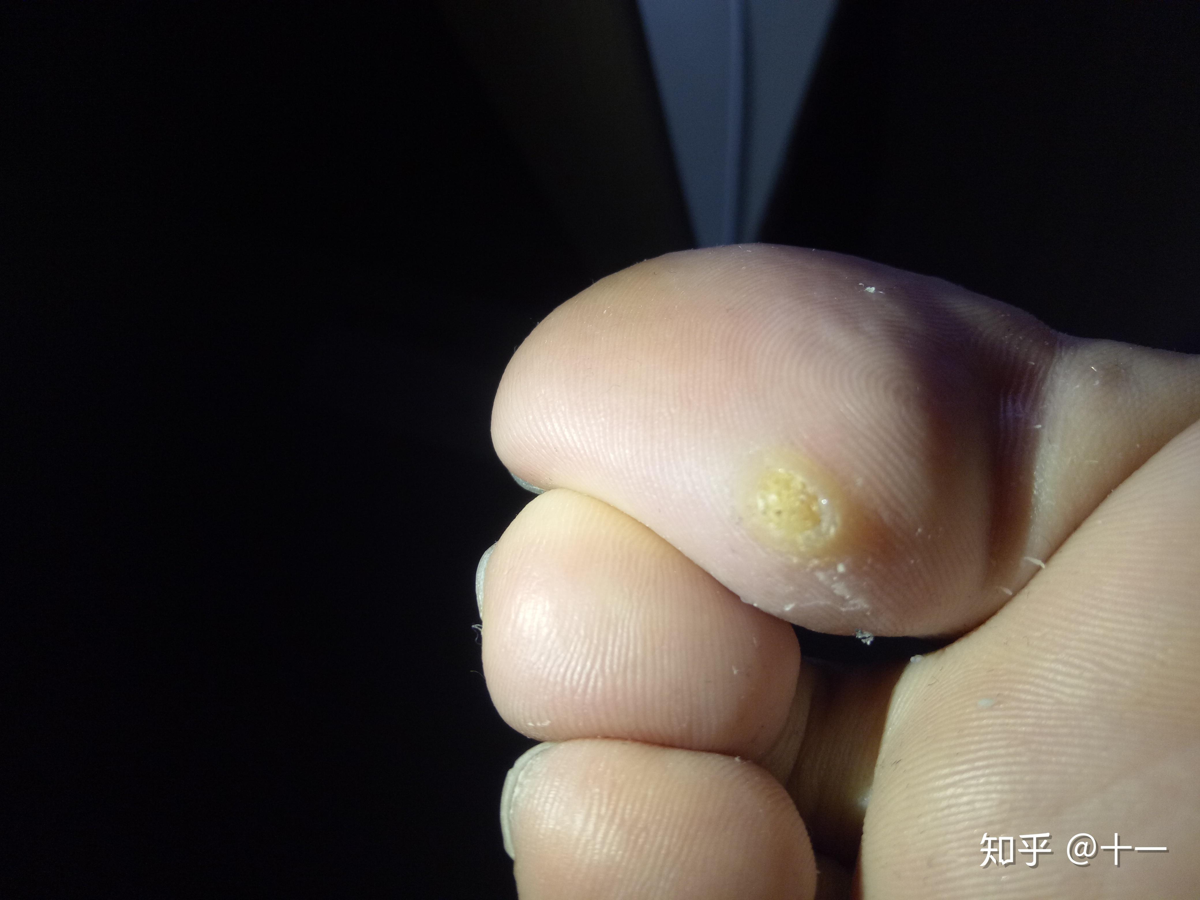 我的趾疣治疗史一个月