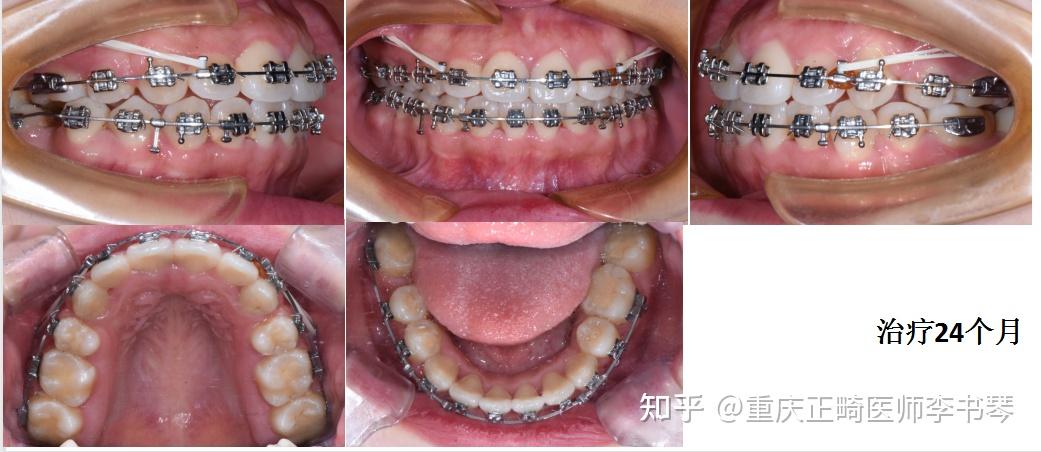 重庆牙齿矫正上颌前突矫正让短下巴长出来