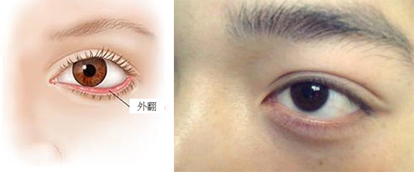 下睑下至丨眼部整形系列科普第二篇