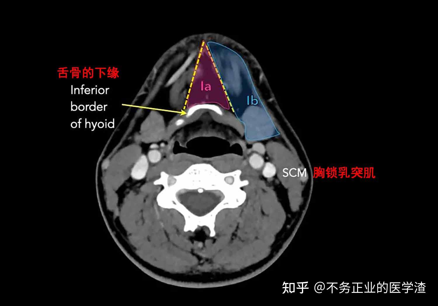 颌下腺位置图片CT图片