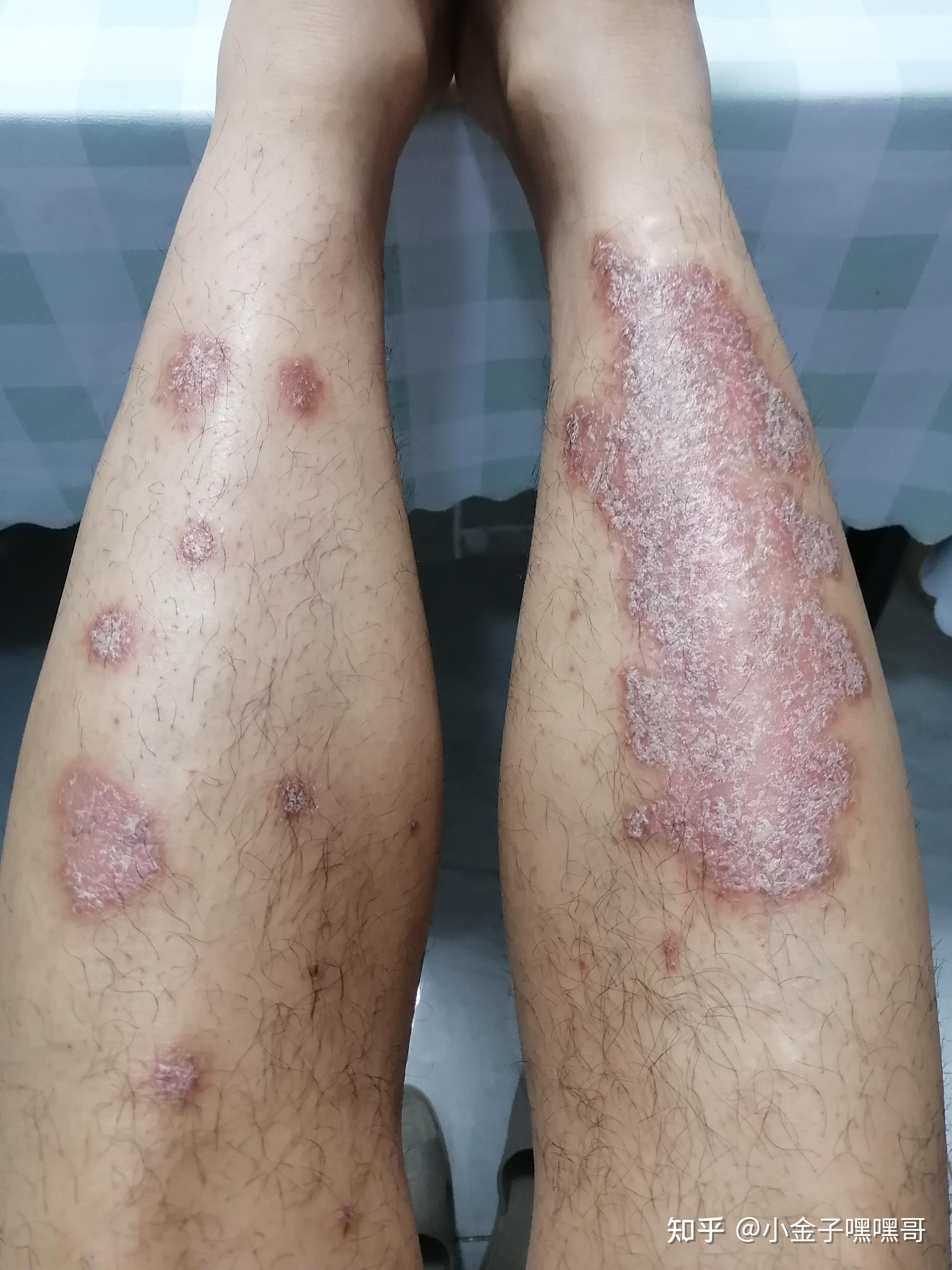 真实记录使用可善挺的效果