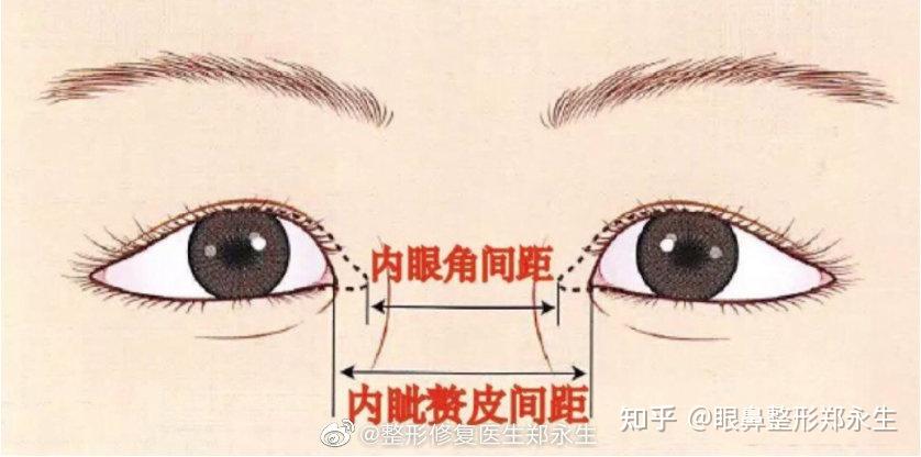 什么是内眦赘皮 - 知乎