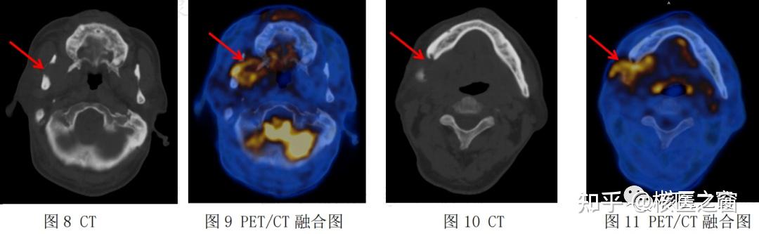 PET/CT与MRI联合诊疗——全面评估与精准诊断的完美结合 - 知乎
