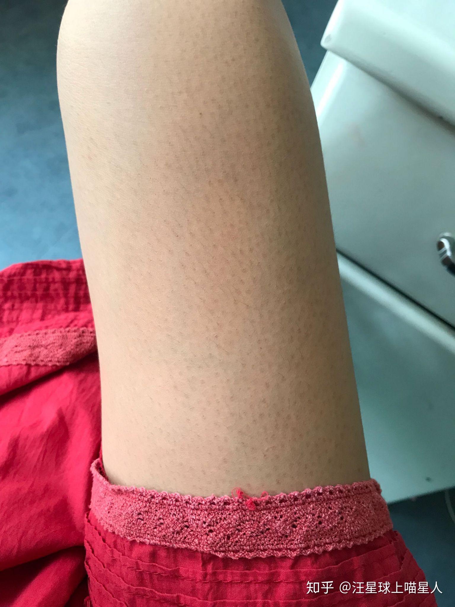 儿童鸡皮肤怎么消除最有效(儿童鸡皮肤怎么消除最有效 腿部手臂)