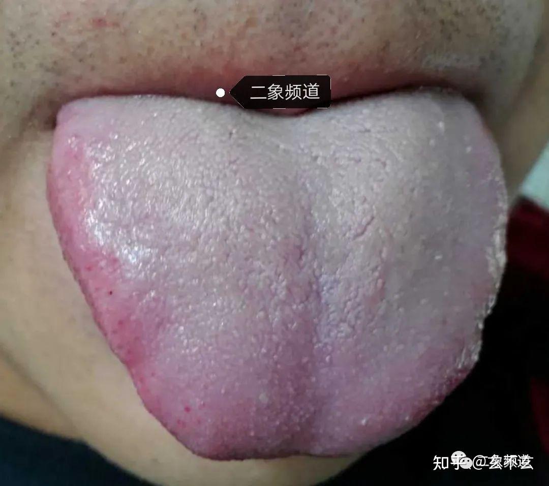 先看舌质,这舌质也是红,但红中略带一点淡,边还有淤血点;再看舌苔