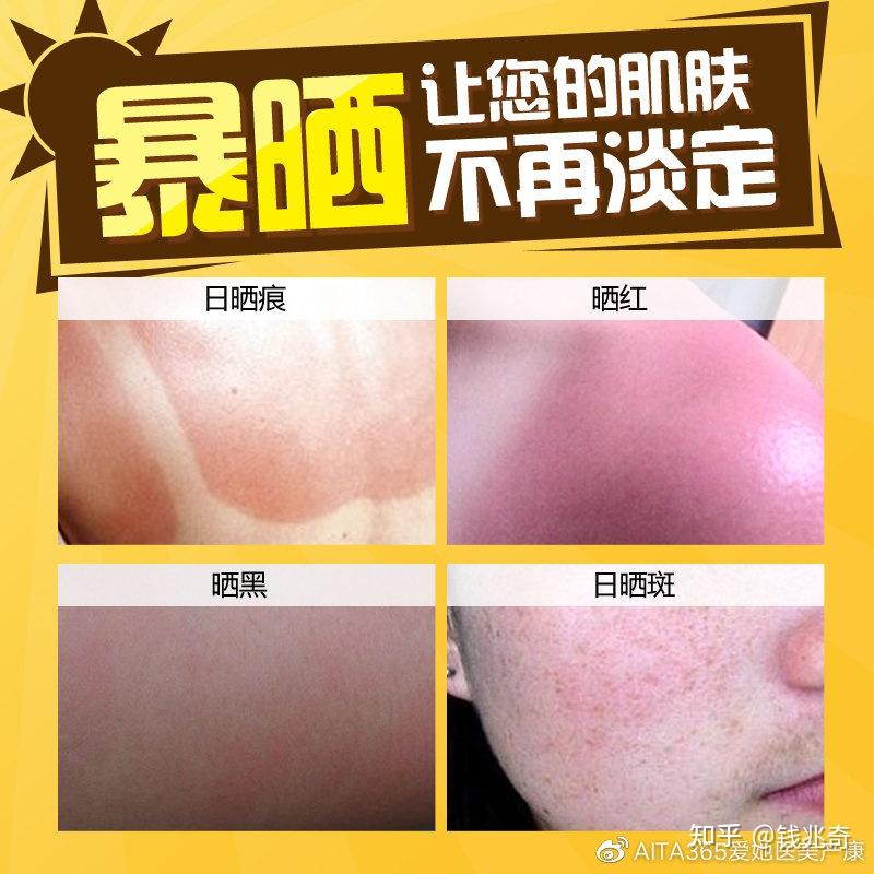 夏季晒伤后第一步到底要干啥? - 知乎