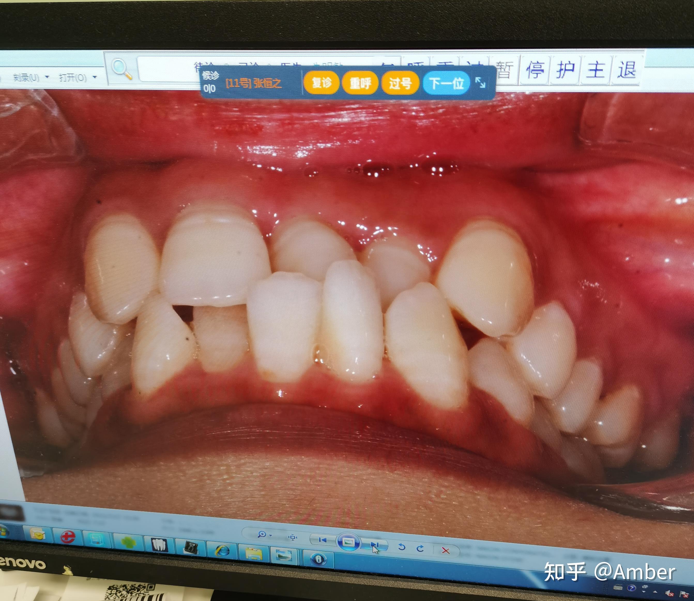 重度牙列拥挤加"地包天"正畸之旅