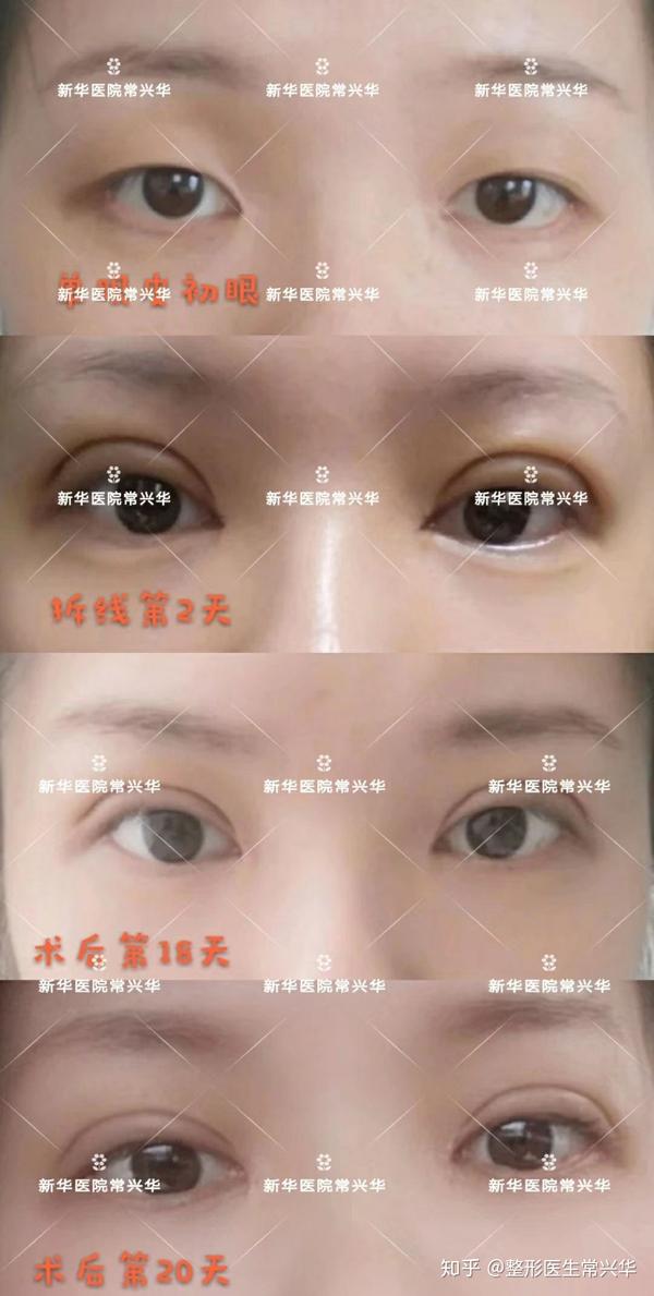 术后20天全切双眼皮反馈