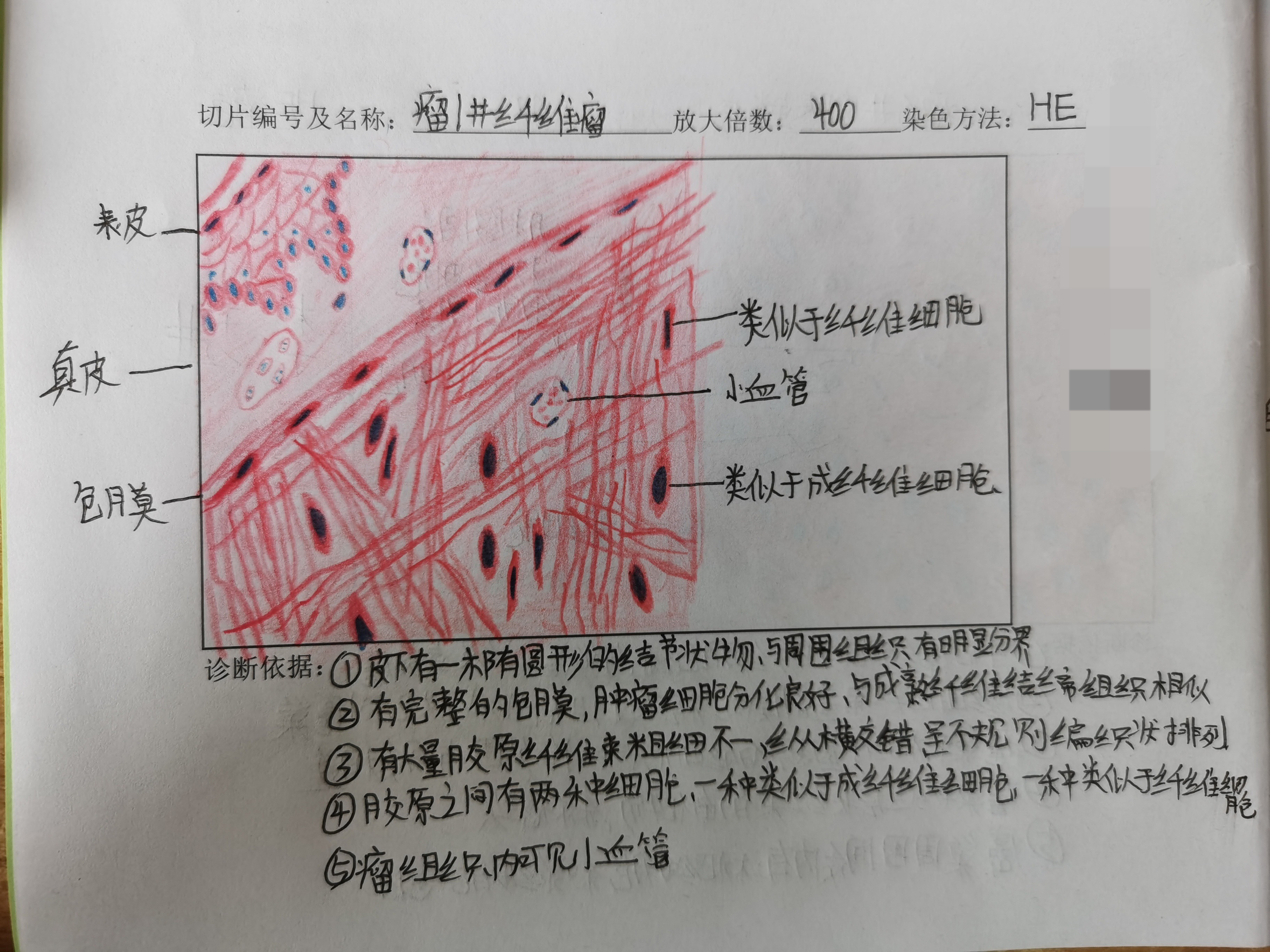 纤维腺瘤红蓝铅笔图图片