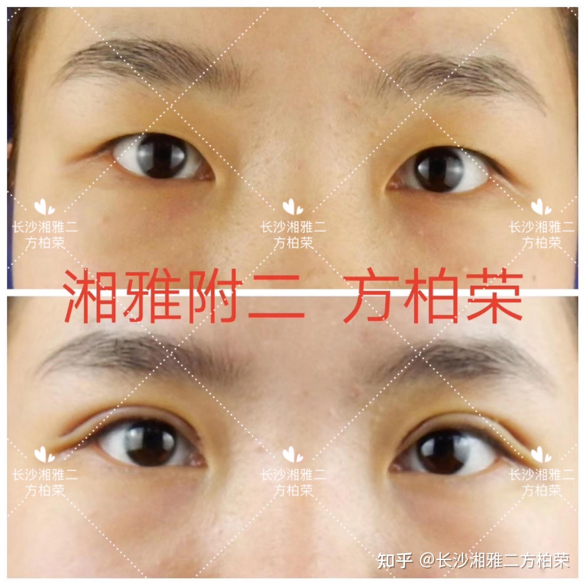 韩国开扇型双眼皮手术经历超详细分享（韩式五点+提肌+开眼角） - 知乎