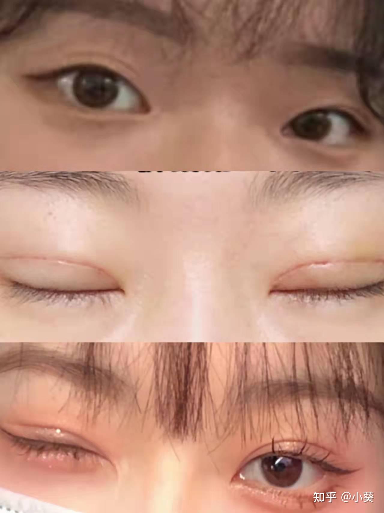 福州双眼皮医生推荐自然妈生的双眼皮