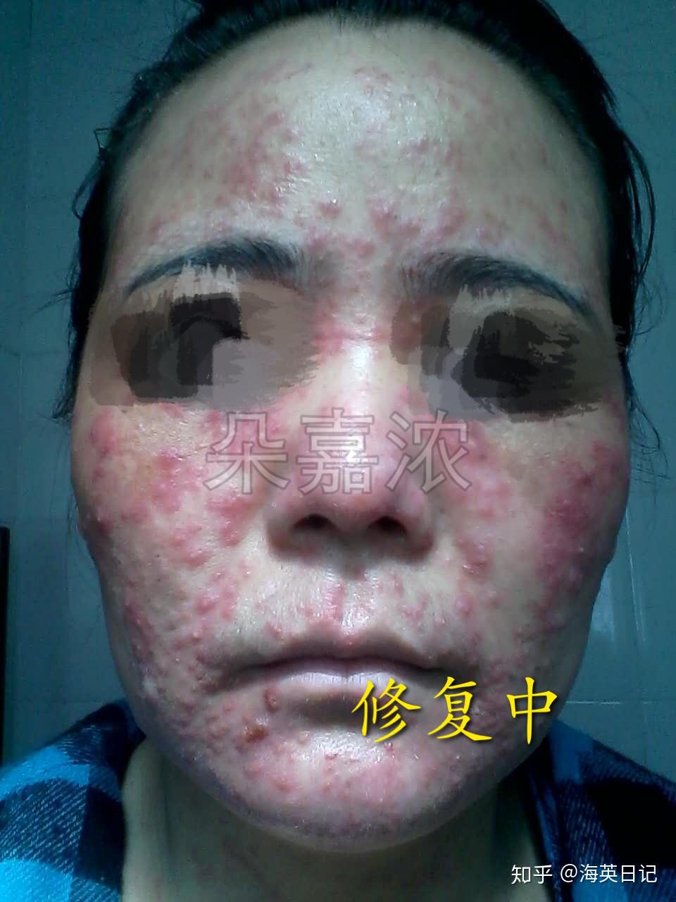 朵嘉浓海英激素脸治疗过程中这几个细节一定要注意彻底治愈激素脸不是