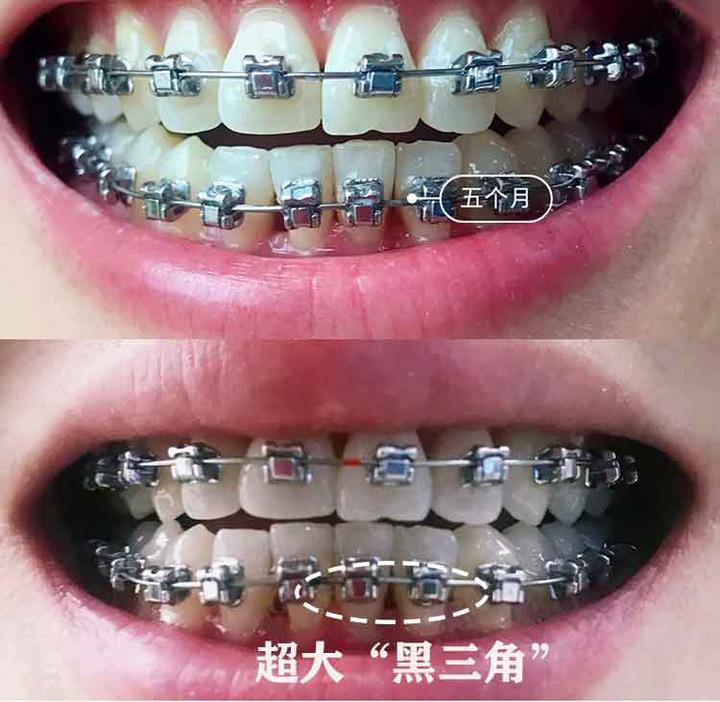 为什么牙齿矫正后有 黑三角 知乎