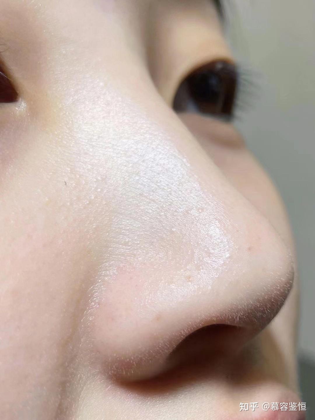 鼻子上毛孔洞怎么修复图片