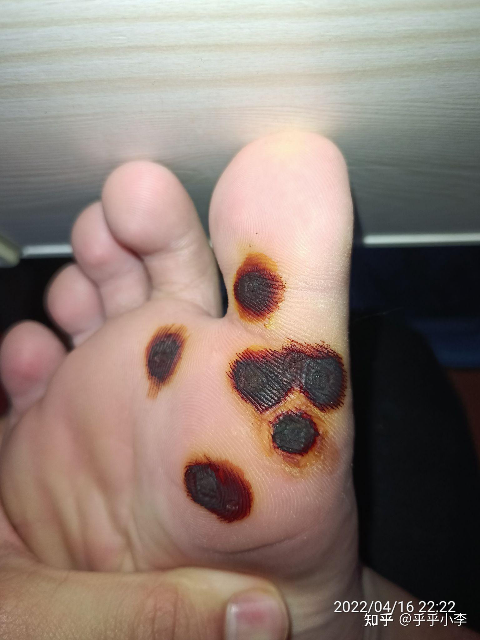 10浓碘酊治疗跖疣