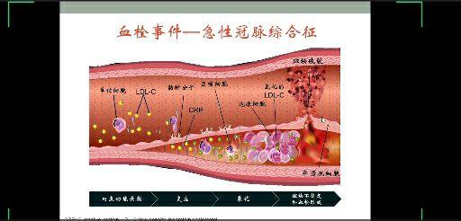 动脉粥样硬化斑块的形成