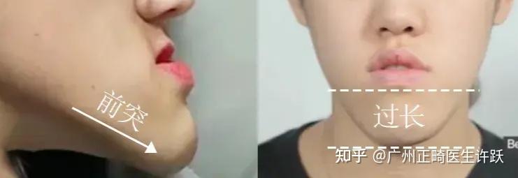 地包天矫正思路!一篇讲清反颌对脸型的影响,以及纠正反颌面型的重点在哪里 - 知乎