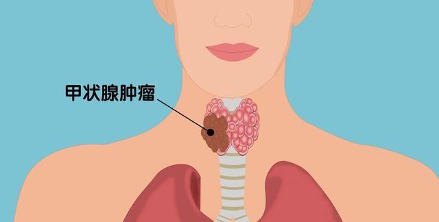什么情况会得甲状腺癌 v2-f1b8709168cb450d7ea86cc7e246731e_1440w.jpg?source=172ae18b