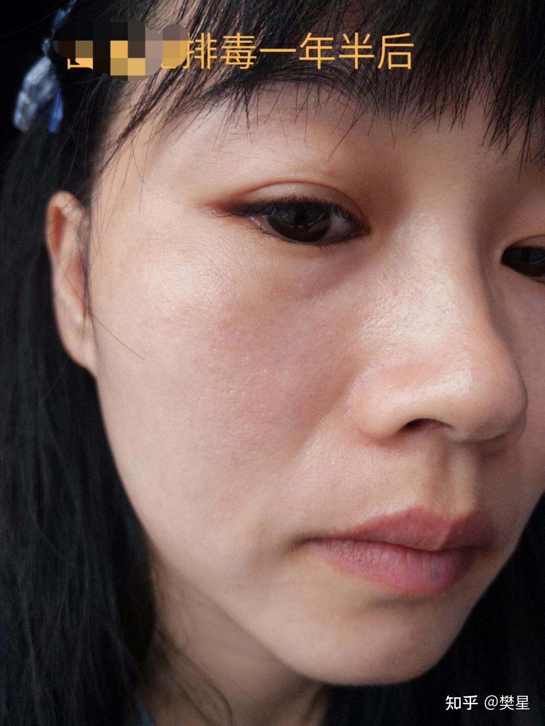 有人激光祛斑反黑的吗,你们都是多久褪的啊,本人因反黑焦虑了? - 知乎