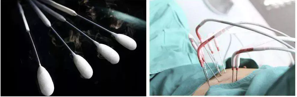 肺部的冷冻消融术简单说