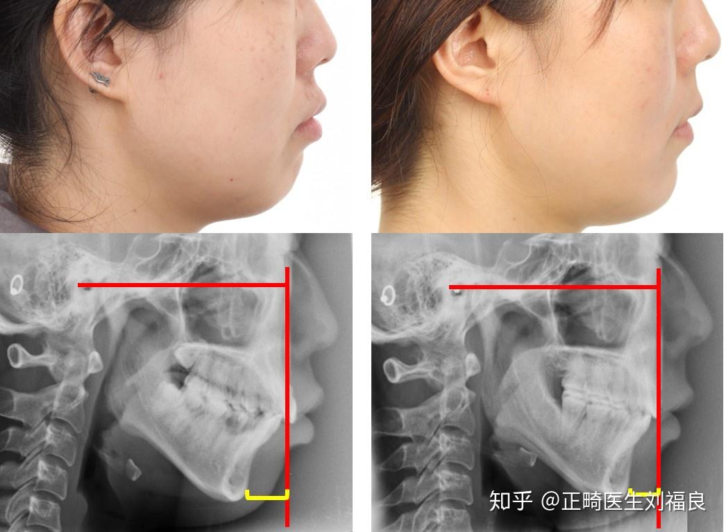 治療也是選項之一,雖然並不能讓下頜大幅度向前,但是通過減少上頜突度