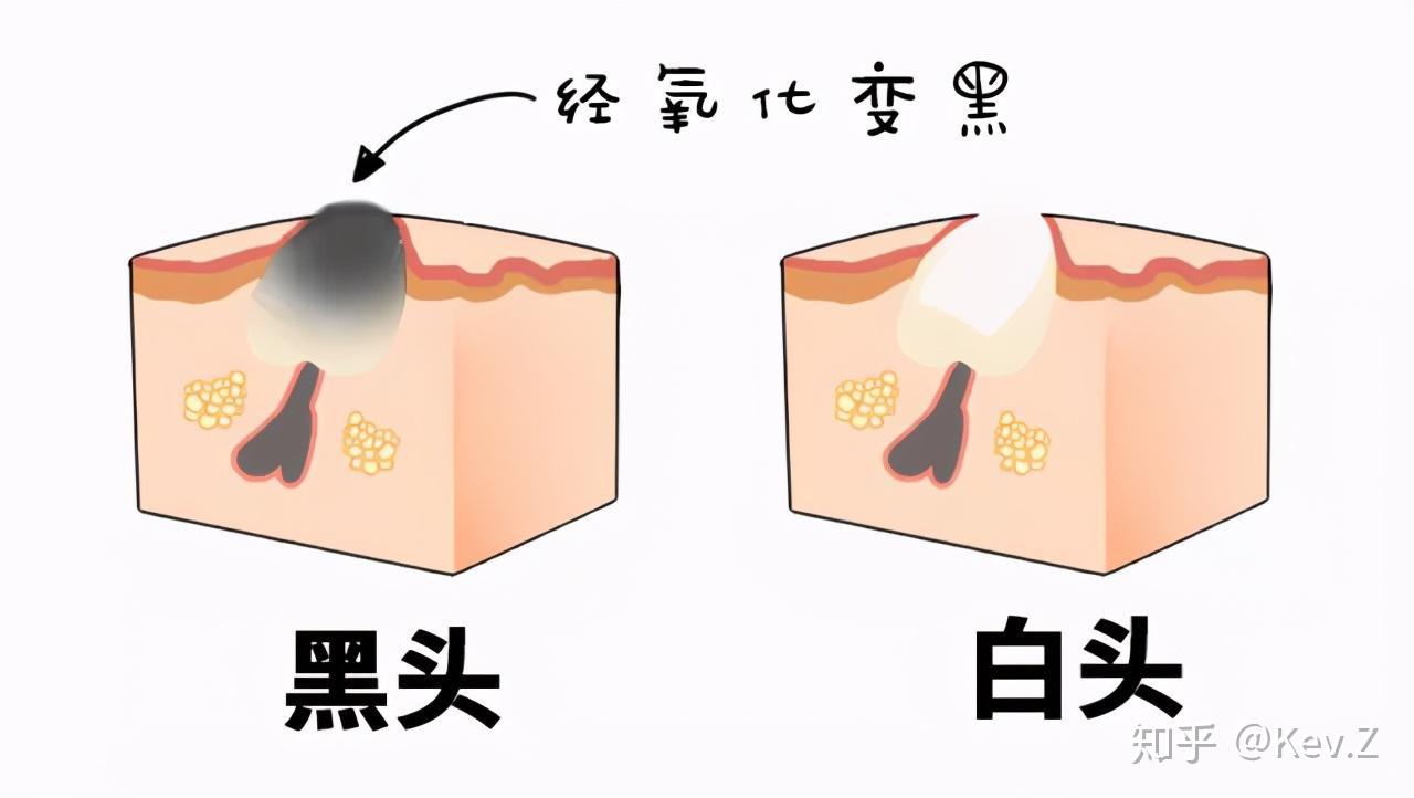 黑头到底是什么