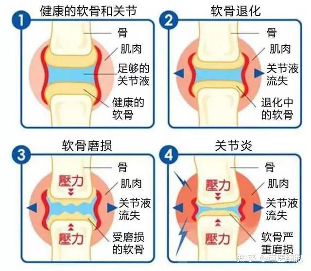 间充质干细胞治疗骨关节炎——调节关节腔内微环境减少炎性因子同时促进关节软骨再生 知乎 0583