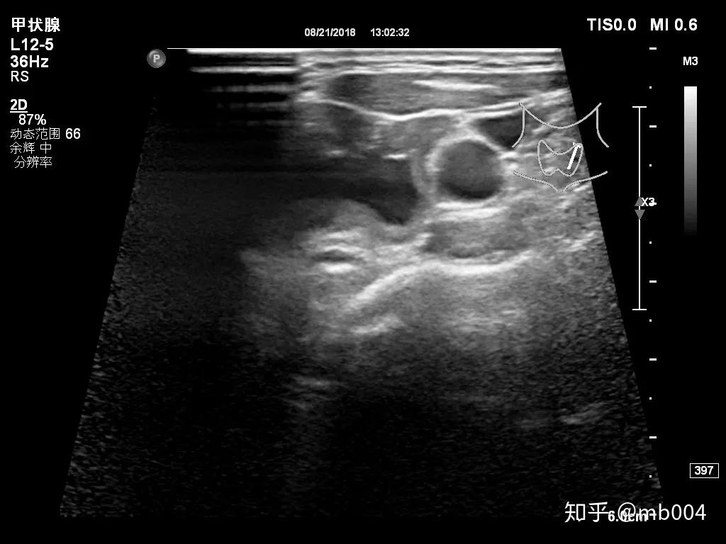 病例7-45 胎儿淋巴水囊瘤-临床医学-医学
