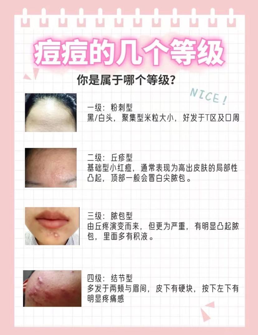 【祛痘/痘印小贴士】护肤配方专家教你如何用四个步骤刷酸去痘/去痘印!不要再反复长时间的痘痘和溃烂!5年的青春痘都可以消除!长痘痘的人都来看!