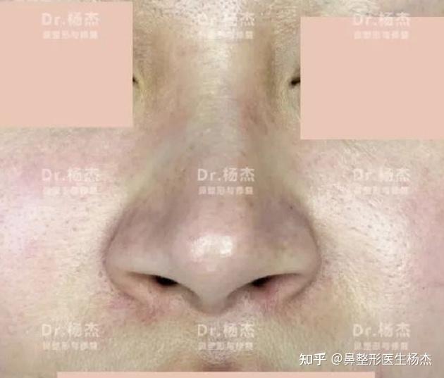 露鼻孔的真相不止一个:浅聊鼻槛与露鼻孔之间的联系 - 知乎