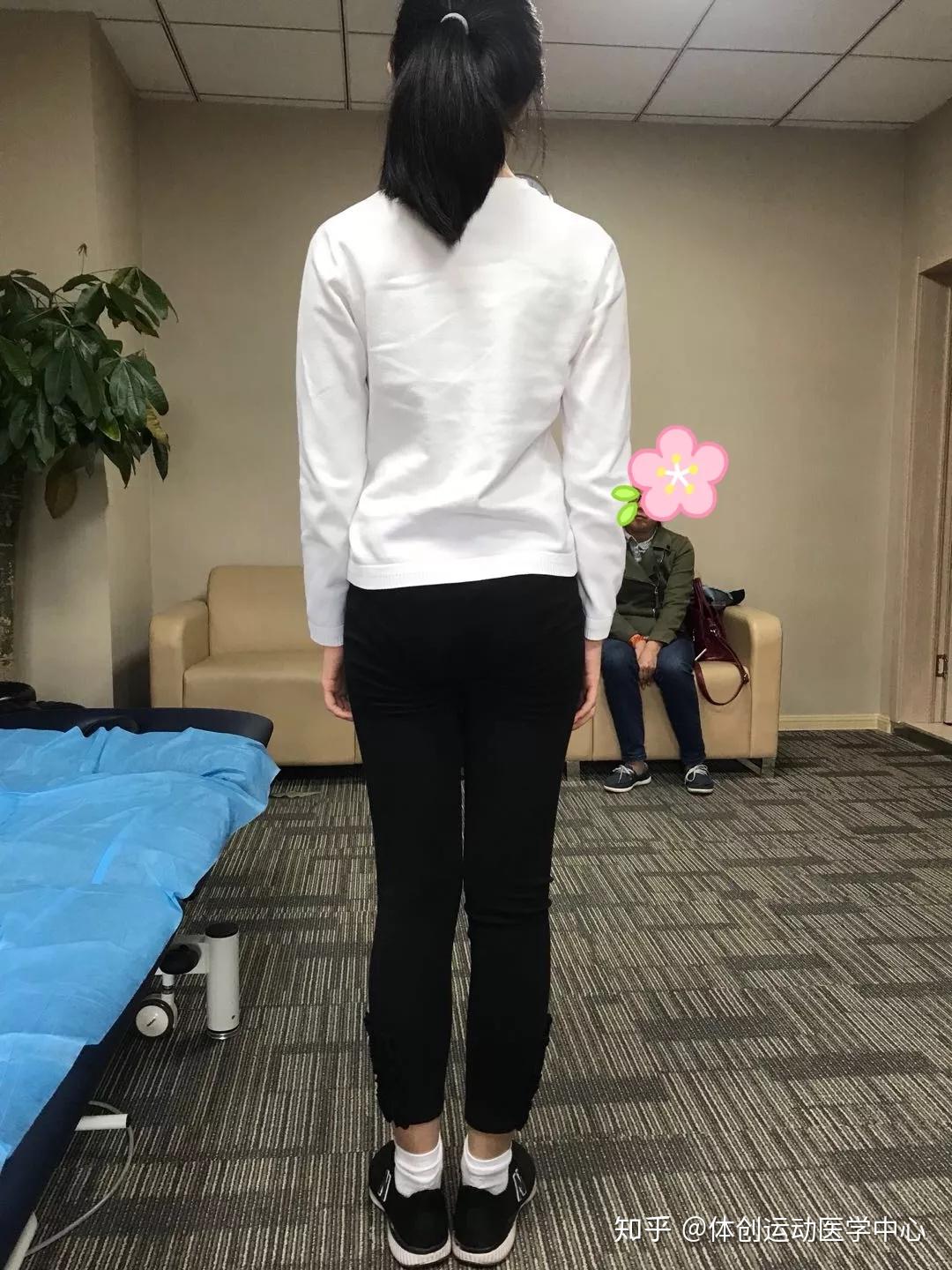 父母认为是学业繁重引起,没有太在意,之后发现小姑娘肩膀不一样高了