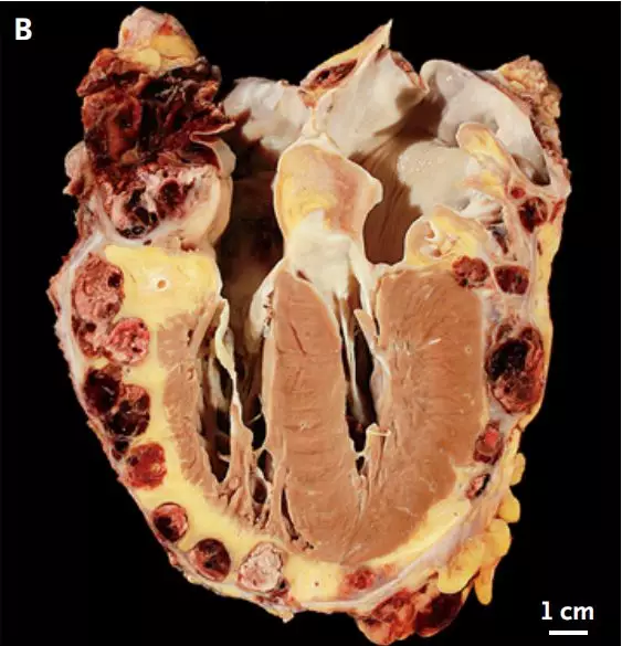 心闻速递心脏血管肉瘤1例nejm肿瘤心脏病学病例
