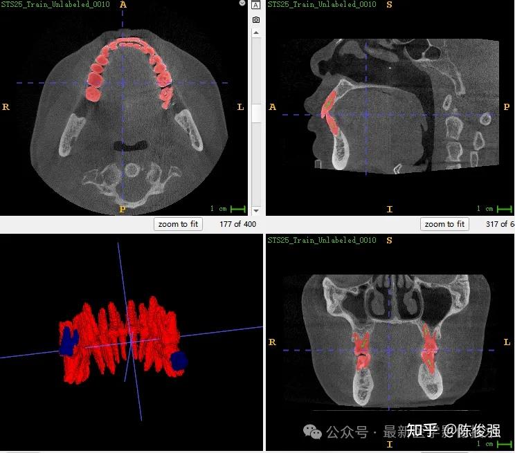 STSR2025——CBCT牙齿分割和CBCT与IOS注册配准 - 知乎