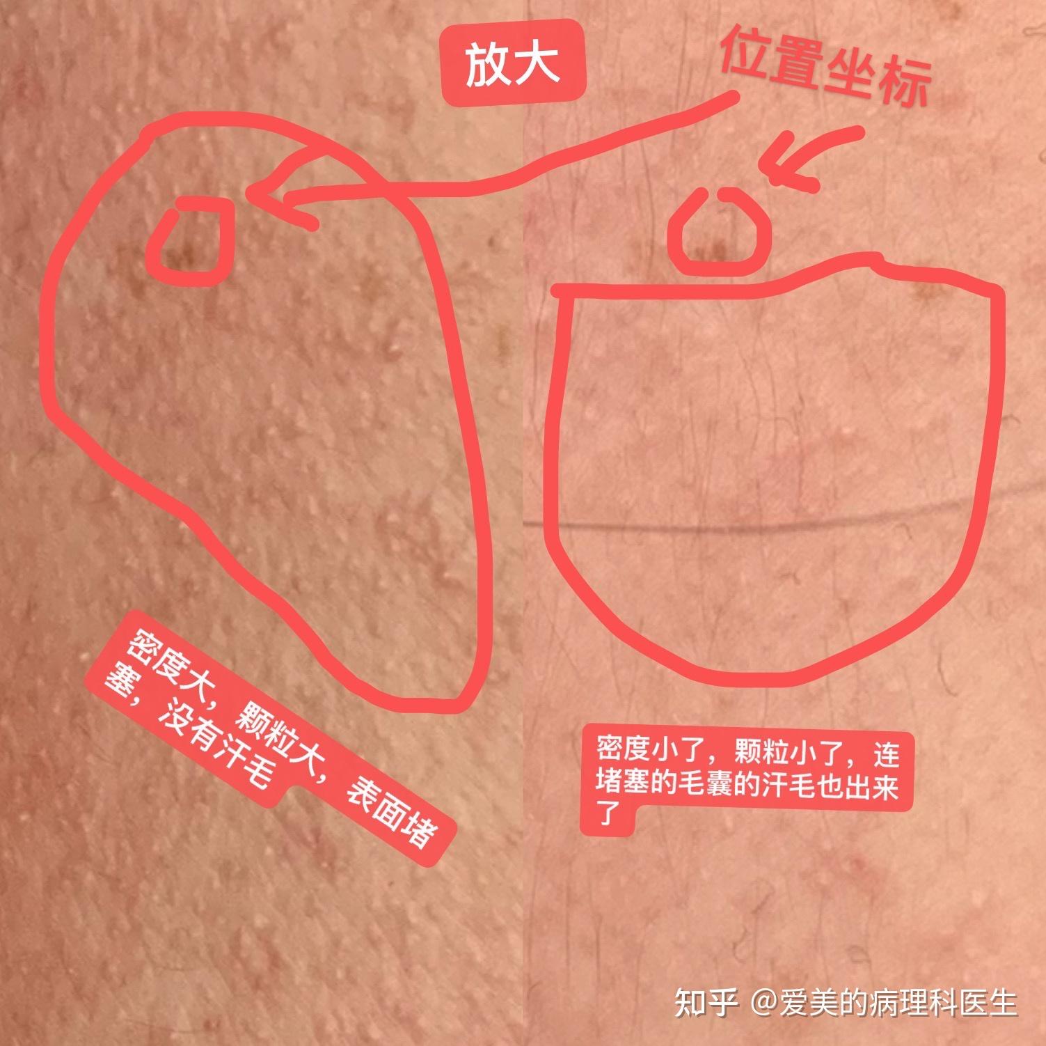 轻度鸡皮肤图片额头(额头有鸡皮肤怎么回事)
