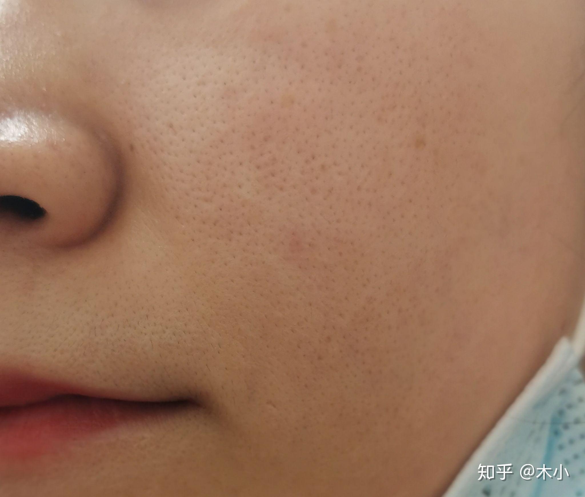 记录一下点阵激光收缩毛孔全过程