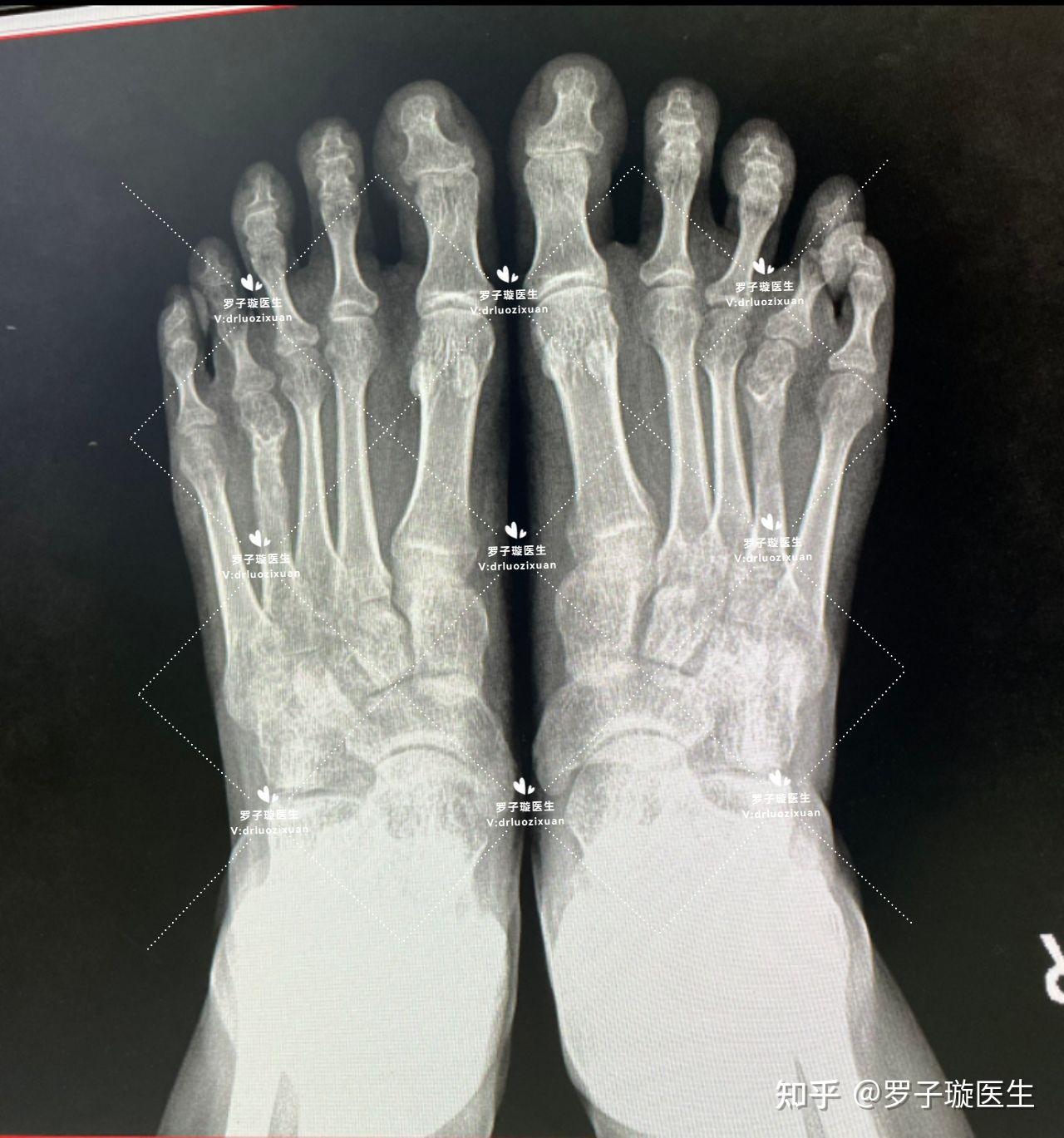 第四脚趾短小症—短趾症—治疗过程 - 知乎