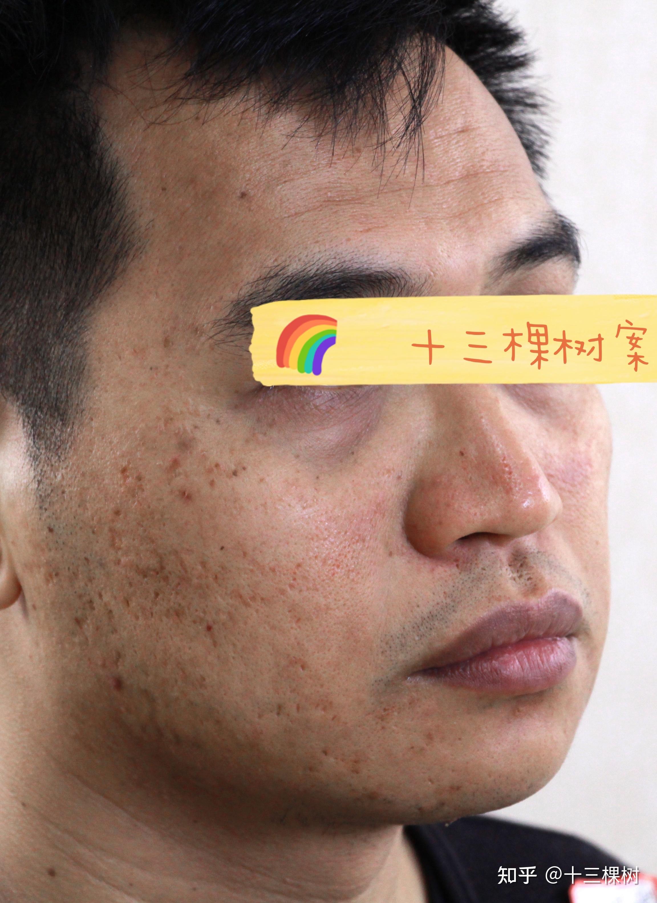 两组综合激光治疗后的痘坑修复效果也太好了吧