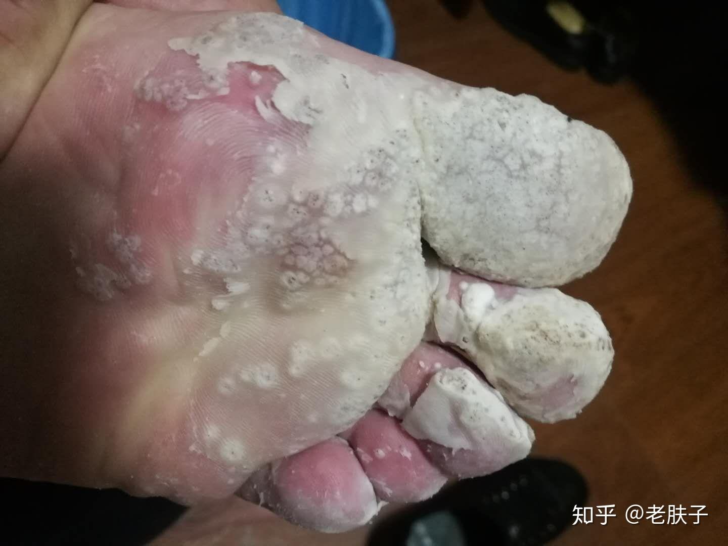 脚底大面积跖疣去除恢复过程图慎点