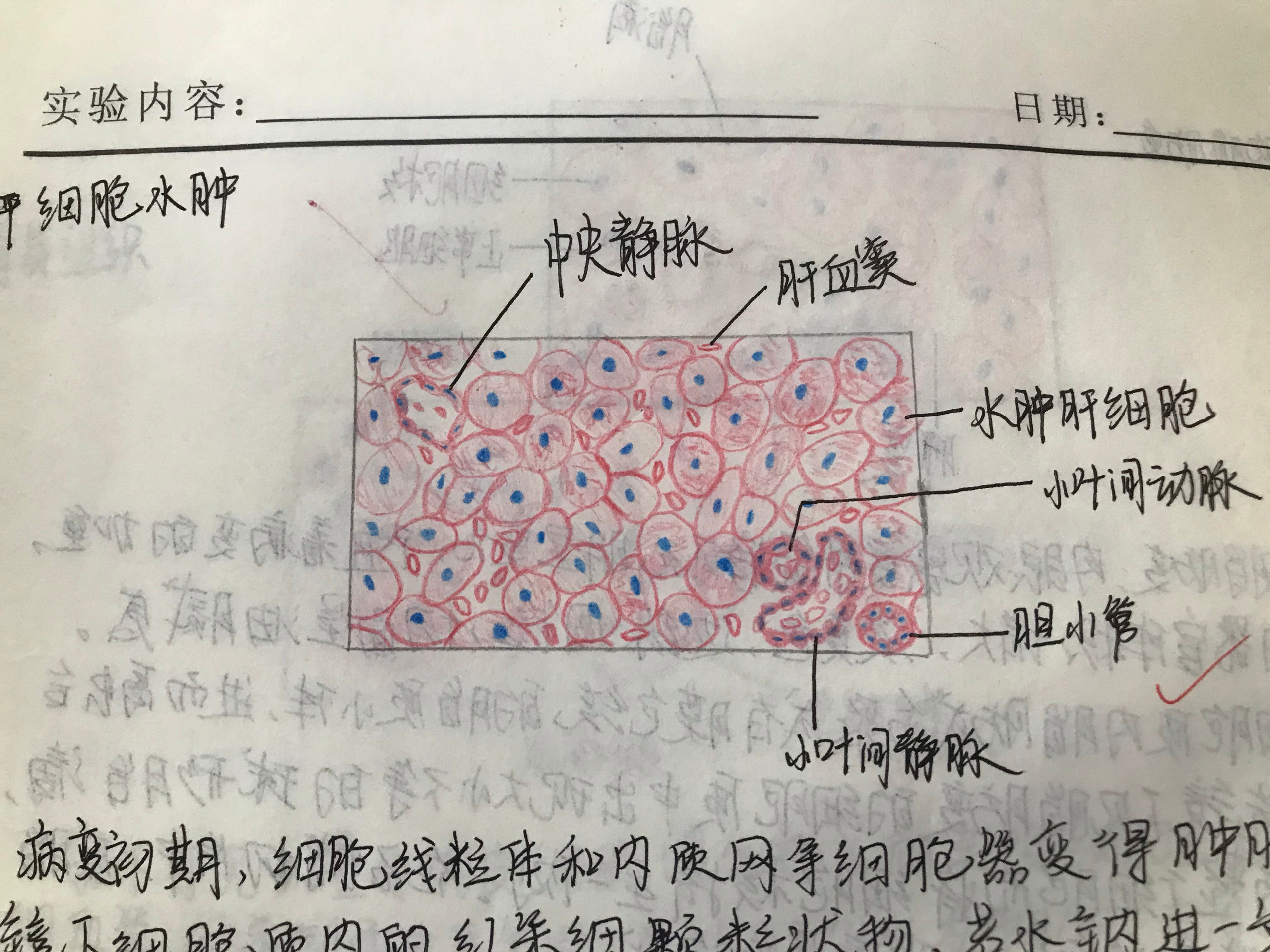肝细胞水肿图 手绘图图片