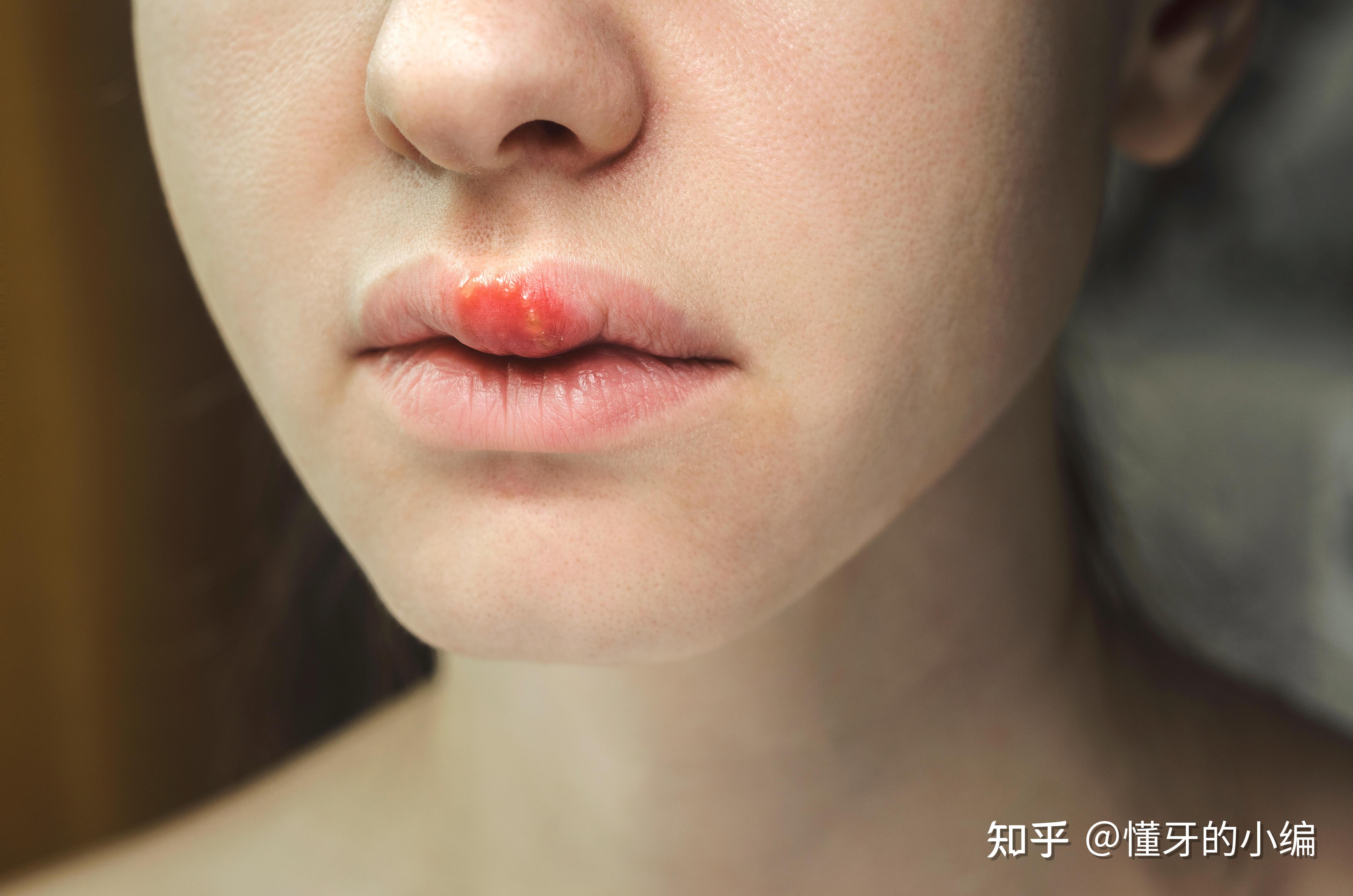 嘴巴長水泡？唇皰疹會傳染嗎？一次搞懂唇皰疹的原因與治療 - Hello 醫師