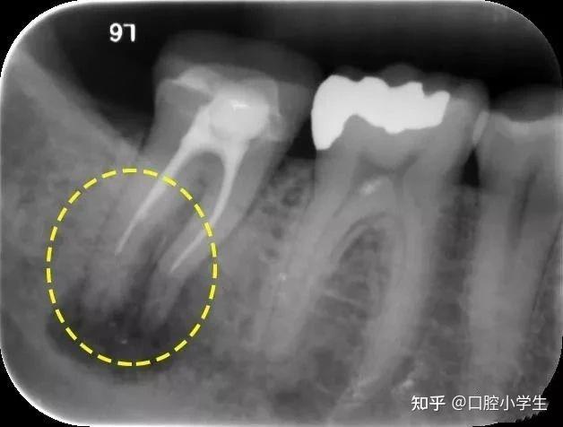 根据根管治疗填充程度的不同,可将其分为超填,欠