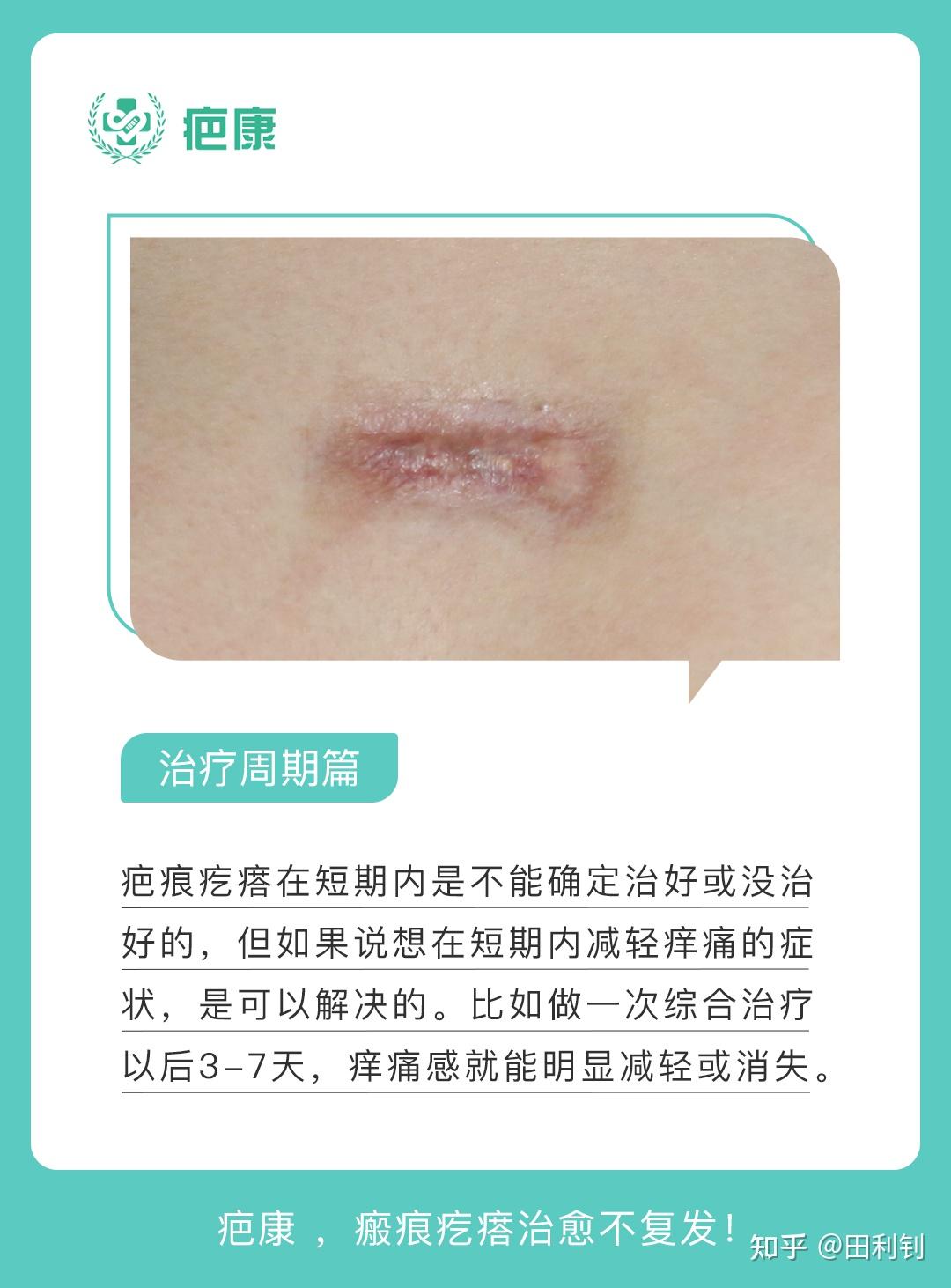 怎样判断疤痕疙瘩彻底治愈了