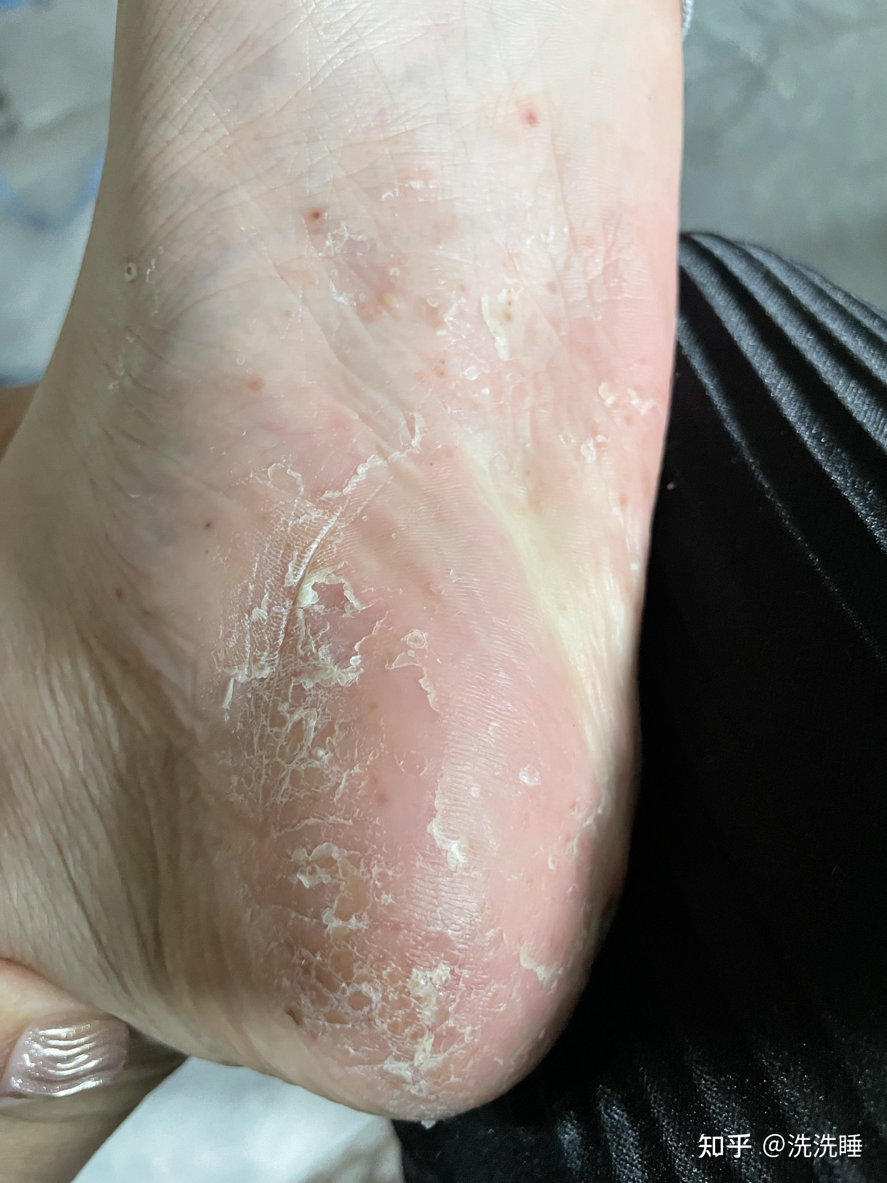 掌跖脓疱病略有好转