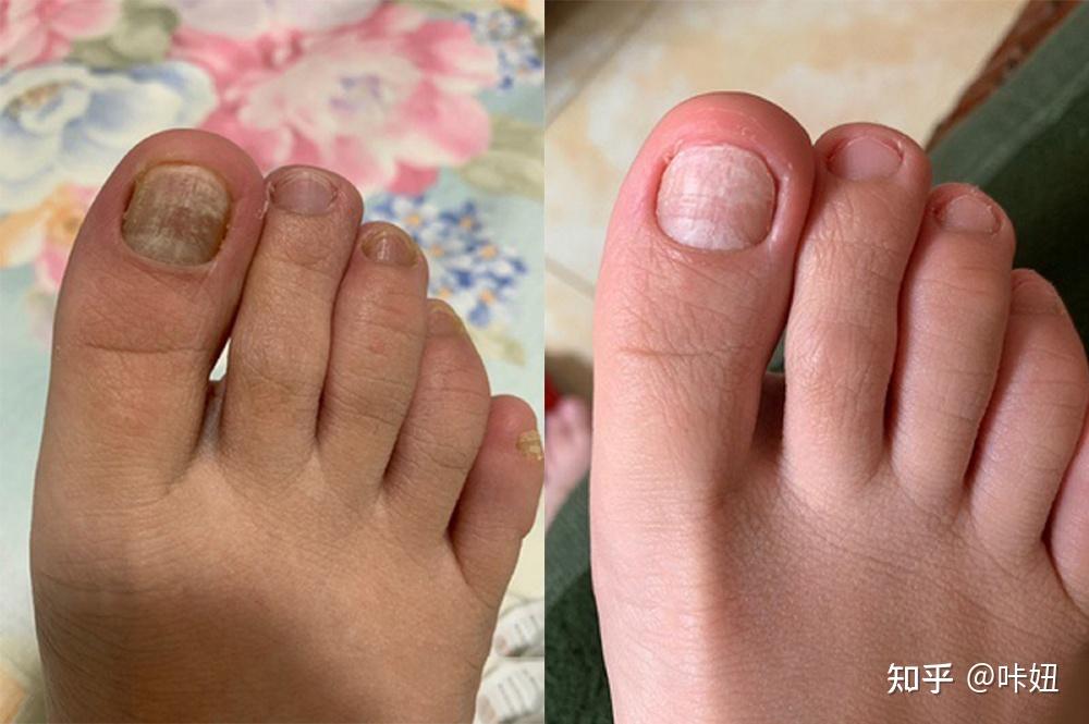 我的这种情况是灰指甲前期症状吗
