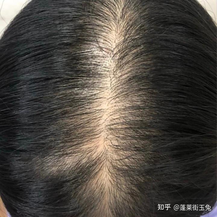 发量多的人都是怎么弄的?有什么特别好用的防脱洗发水推荐一下吗?求求了,脱发女大学生也想变成发量富婆? - 知乎