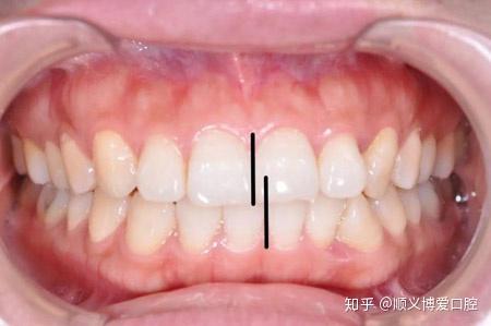再者,咬合错位后,上下牙门牙中缝不齐,牙齿排列也不整齐,实在是影响