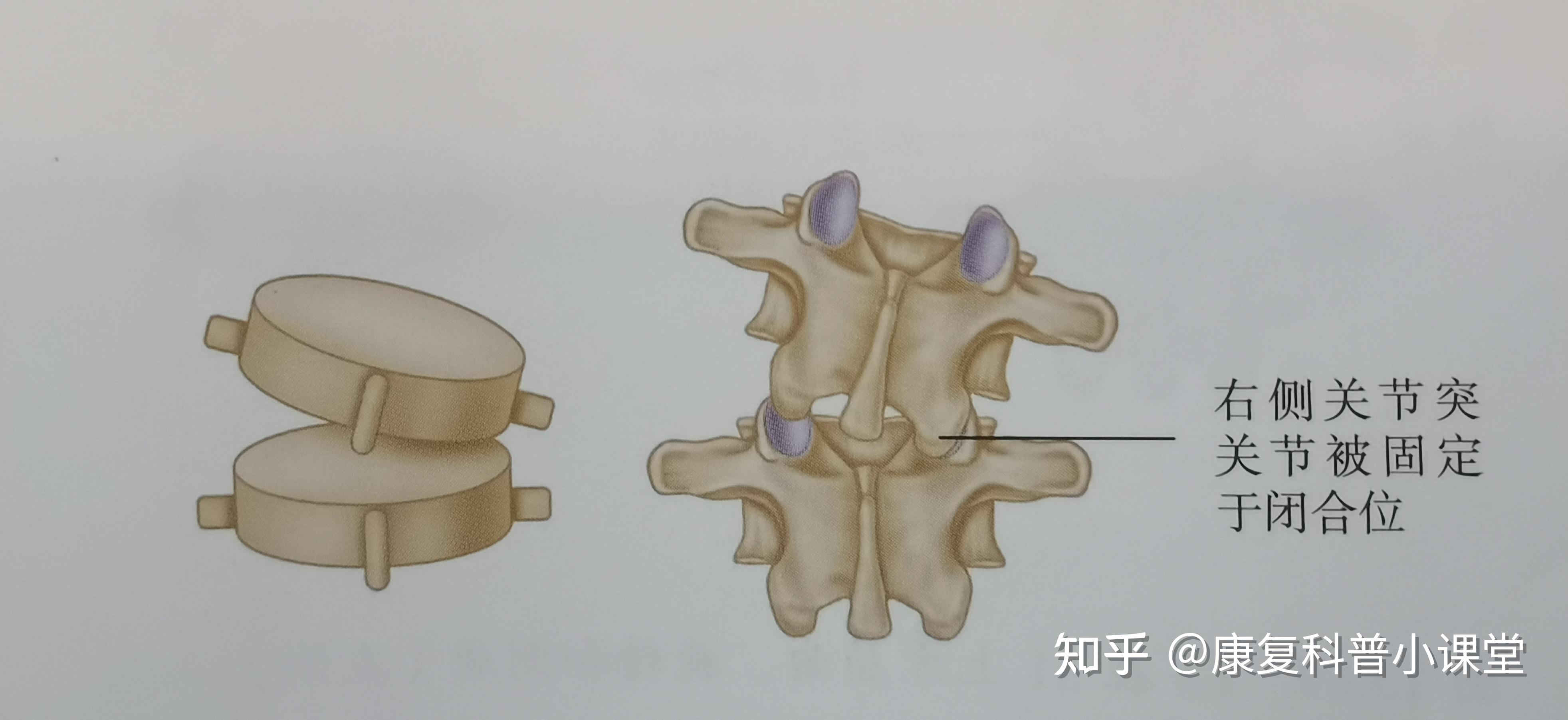 使腰椎向后侧屈,以打开左侧本处于闭合位置的l5/s1关节突关节