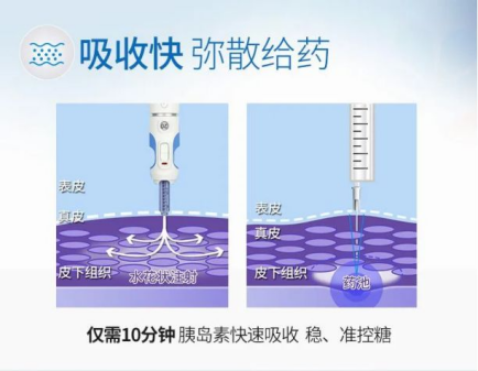 打胰島素你是贊成胰島素泵還是無針注射器