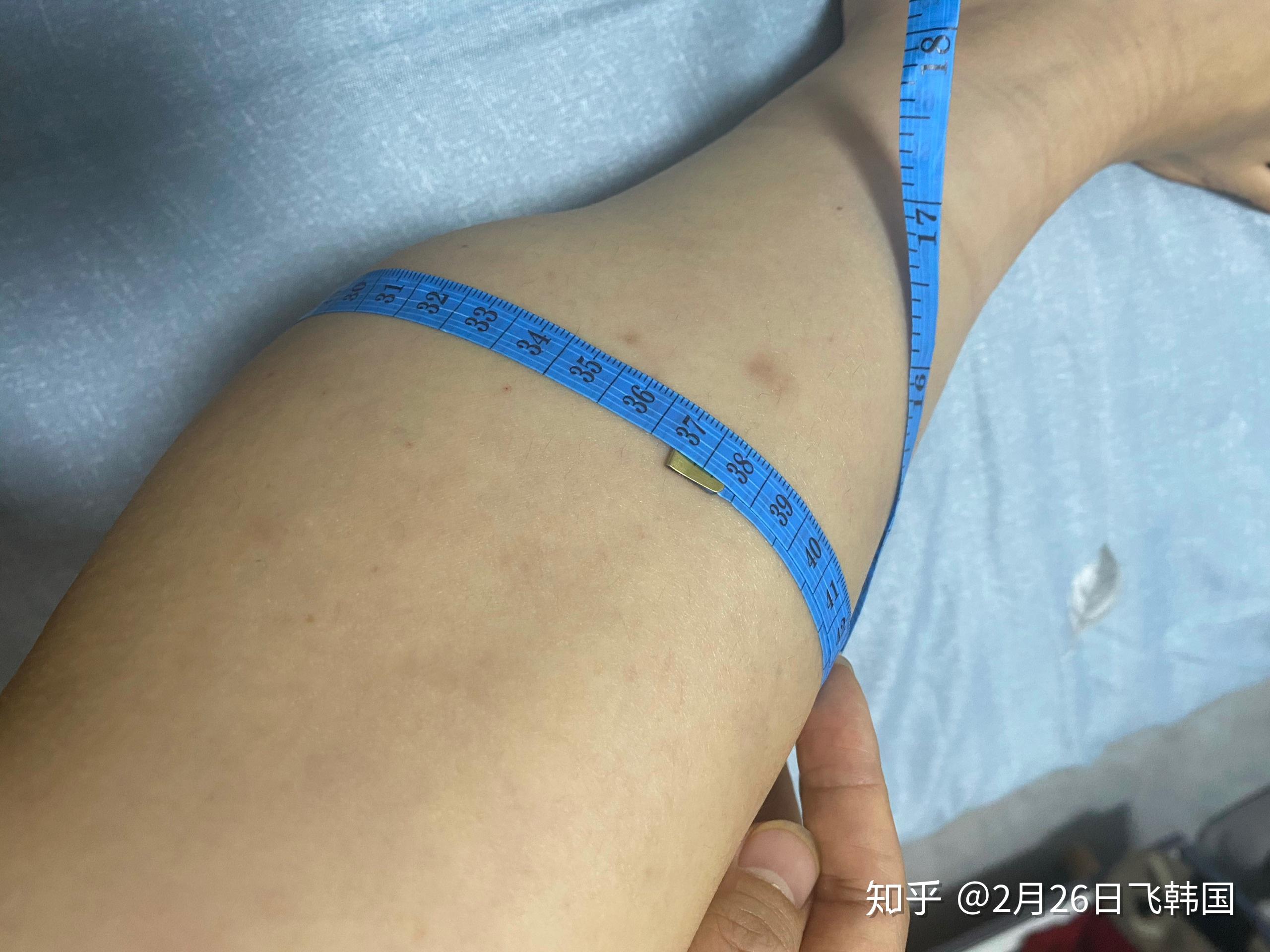 小腿围36厘米的姑娘打瘦腿针全过程